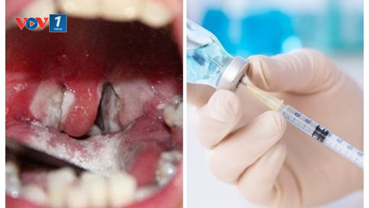 Dịch bạch hầu: Ngăn chặn các nguy cơ dịch bệnh từ “vùng lõm” tiêm chủng (30/6/2020)