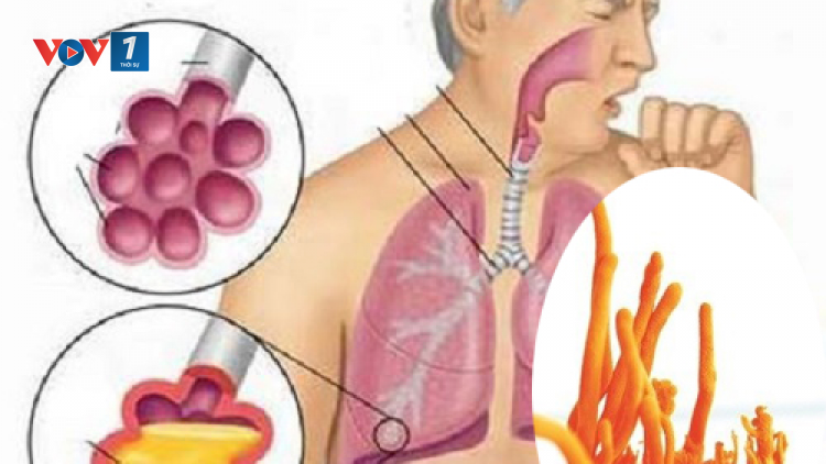 Tác dụng của Đông trùng hạ thảo cho người mắc các bệnh về đường hô hấp (13/11/2021)