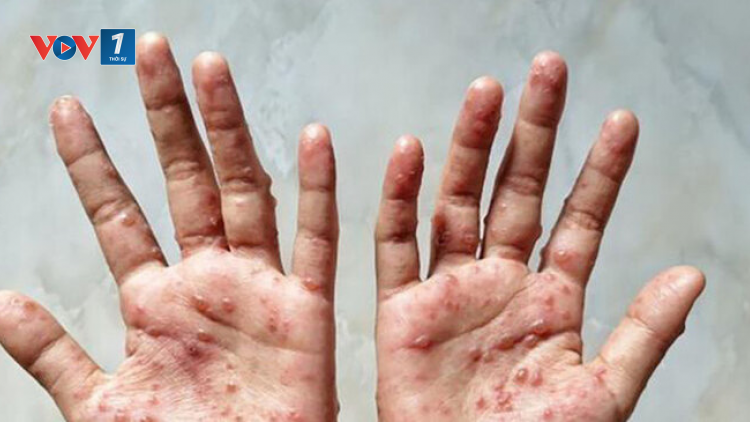 Diễn biến bệnh đậu mùa khỉ và các giải pháp phòng ngừa (22/10/2023)