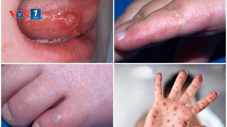 Cảnh giác cao với bệnh tay chân miệng! (17/6/2023)