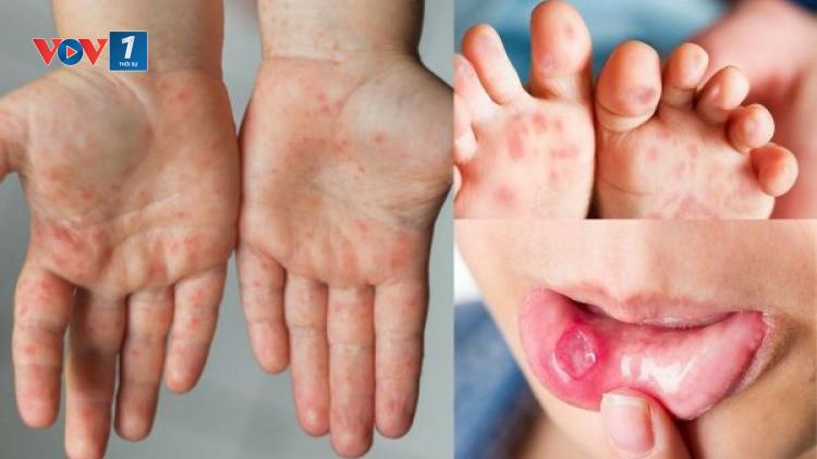 THỜI SỰ 21H30 ĐÊM 31/7/2023: Cục Quản lý dược, Bộ Y tế cho biết đã có nguồn cung thuốc điều trị bệnh tay chân miệng