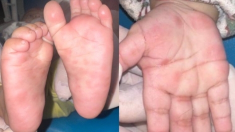 Bệnh nhi 4 tháng tuổi nhiễm giang mai do lây truyền từ mẹ (16/04/2025)