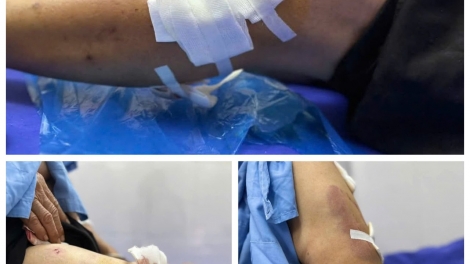 Nhiều trường hợp bị chó tấn công ở Yên Bái (07/05/2025)