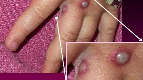 Thái Lan cảnh báo bệnh đậu mùa khỉ.