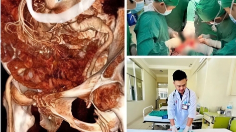 Phẫu thuật cứu sống cụ bà vỡ phình động mạch chủ bụng