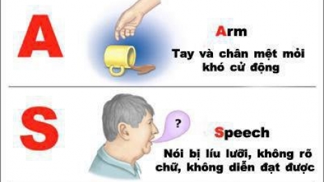 Điều trị kịp thời cho bệnh nhân đột quỵ 