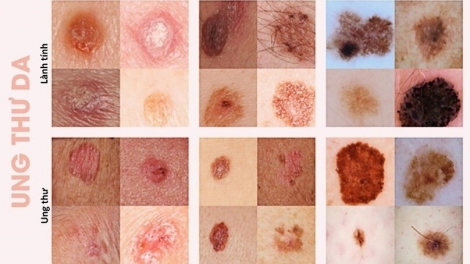 Ung thư tế bào hắc tố: Phát hiện sớm là "chìa khòa vàng" trong điều trị