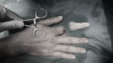 Hồi sinh ngón tay cho thủy thủ sau 25 giờ bị đứt rời