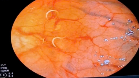 Người phụ nữ nhiễm giun nặng vì thói quen ăn rau sống