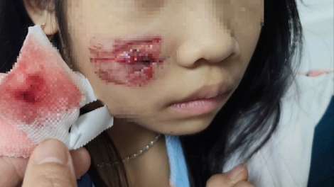 Đang chơi tại sân nhà, bé gái bị khỉ hoang tấn công gây thương tích