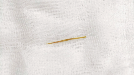 Cảnh báo nguy cơ thủng ruột do nuốt nhầm tăm tre