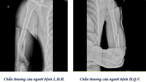 Cảnh báo nguy cơ gãy tay từ trò chơi vật tay