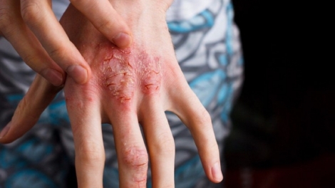 Phòng ngừa các bệnh dịch do giun sán, ký sinh trùng