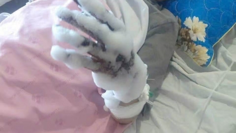 Thanh Hóa: 1 công nhân bị bỏng nặng trong quá trình lao động