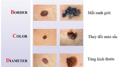 Ung thư tế bào hắc tố: Ung thư da tiềm ẩn từ tổn thương không đau, không ngứa