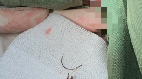 Lấy dị vật kim khâu tầng sinh môn sau 11 năm 