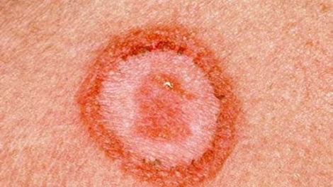 Khuyến cáo từ trường hợp trẻ mắc giang mai bẩm sinh