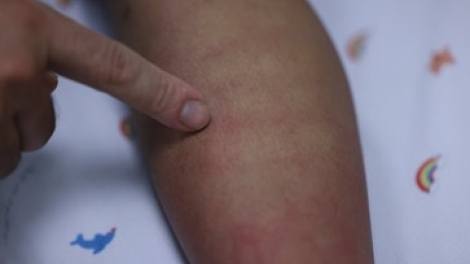 TP.HCM: nhiều trường hợp mắc sốt xuất huyết, trong đó nhiều ca bị sốc nặng, tổn thương đa cơ quan