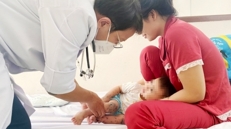 Ca tay chân miệng ở TP.HCM tăng cao
