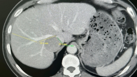 Bệnh nhân u gan từng được khuyên không phẫu thuật, được mổ thành công