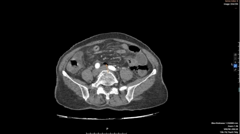 Giành lại sự sống từ ca thủng đại tràng hiếm gặp