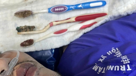 Bệnh nhân nuốt 3 bàn chải được  cứu bằng nội soi