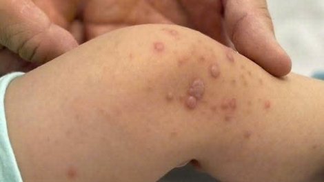 Cảnh báo virus EV71 khiến trẻ mắc tay chân miệng chuyển nặng, gia tăng nguy cơ tử vong
