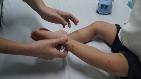 4 ca tử vong do tay chân miệng, Bộ Y tế yêu cầu tăng cường kiểm soát lây nhiễm