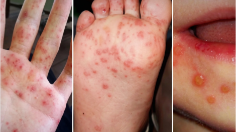 Cảnh báo từ chủng EV71 và giải pháp giảm ca nặng