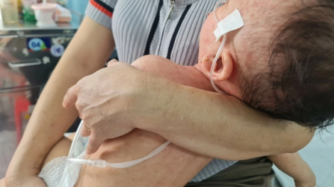 Indonesia bùng phát bệnh sởi, ghi nhận ca tử vong đầu tiên trong nhân viên y tế