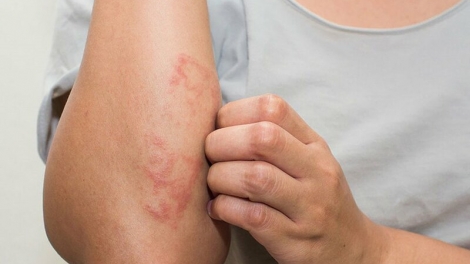 Từ tổn thương ngoài da phát hiện bệnh viêm mạch hiếm có thể gây suy đa cơ quan