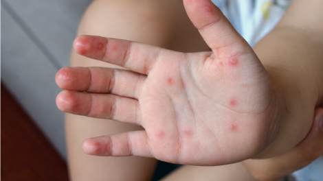 Gần 1000 ca tay chân miệng – làm sao để bảo vệ trẻ nhỏ trong năm học mới
