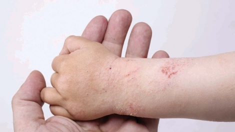 Phòng và điều trị các bệnh về da trong thời tiết giao mùa (3/11/2017)