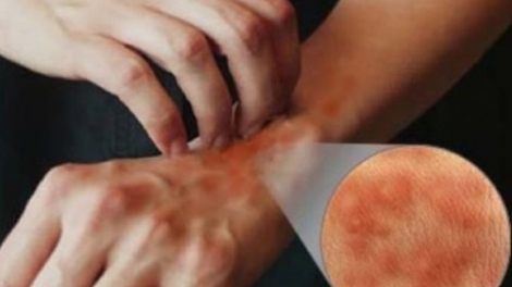 Phương pháp mới trong việc điều trị các bệnh khó chữa về da (11/4/2017)