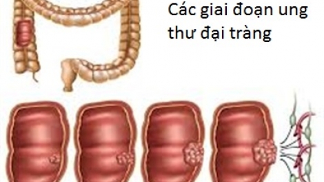 Phương pháp mới điều trị ung thư đại trực tràng giúp giảm độc tính hóa trị, giảm tác dụng phụ, đáp ứng với quá trình chữa trị tốt hơn. (Thời sự đêm 31/01/2018)