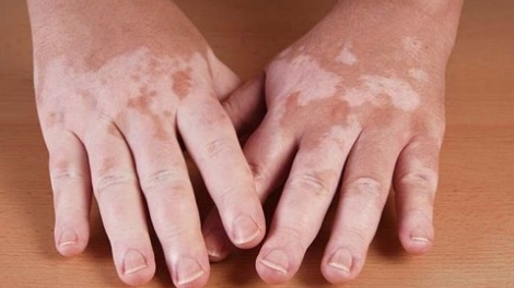 Bát nháo thị trường thuốc chữa bệnh bạch biến (20/12/2018)