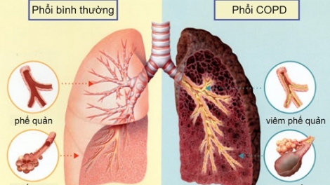 Bệnh phổi tắc nghẽn mạn tính và những điều cần biết (23/12/2018)