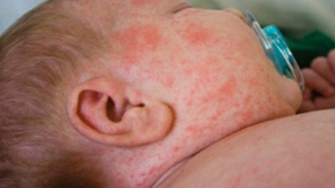 Cách nhận diện và phòng tránh bệnh Sởi (14/1/2019)