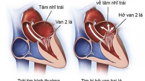 Tư vấn về cách điều trị và phòng bệnh thấp tim (30/12/2019)