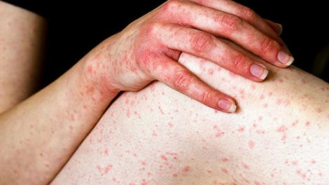 Tư vấn điều trị các bệnh về da khi thời tiết giao mùa (11/5/2019)