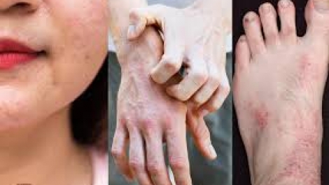 Bệnh viêm da dị ứng vào mùa hè: Nguyên nhân và hướng điều trị (22/6/2019)