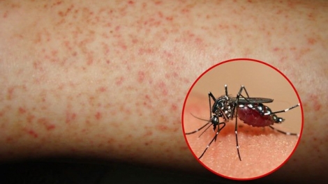 Dịch sốt xuất huyết đang ở mức đỉnh điểm (9/9/2019)