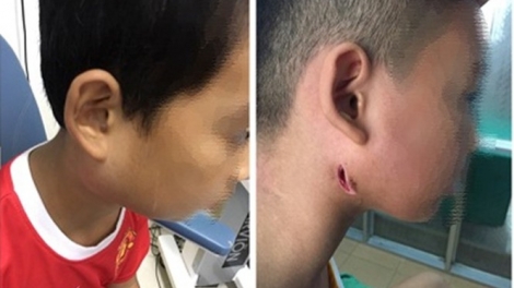 Bệnh do vi khuẩn Whitmore: Kiểm soát bệnh từ ý thức của mỗi người (21/9/2019)