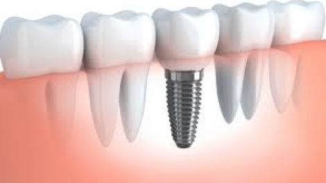Công nghệ cấy ghép Implant trong nha khoa (14/1/2020)