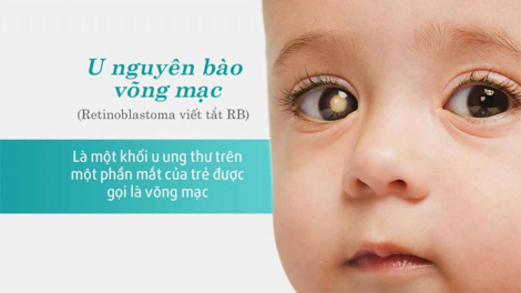 Cảnh giác với căn bệnh ung thư võng mạc (23/12/2020)