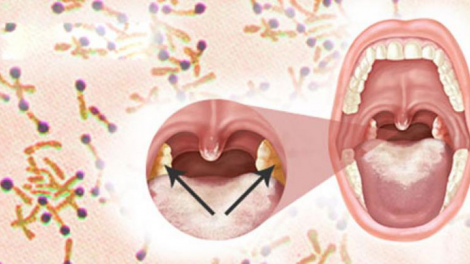 Những cách phòng chống và điều trị bệnh bạch hầu (27/7/2020)