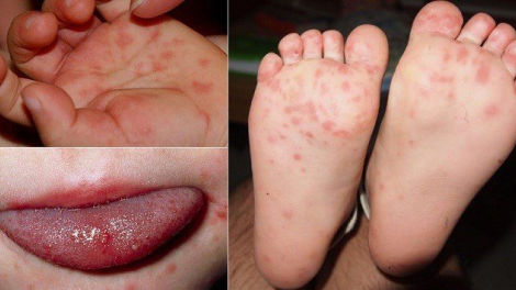 Lâm Đồng: 11 trẻ phải nghỉ học vì mắc bệnh tay chân miệng (15/9/2020)