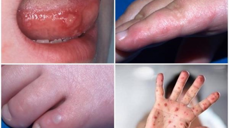 Cảnh giác cao với bệnh tay chân miệng! (17/6/2023)