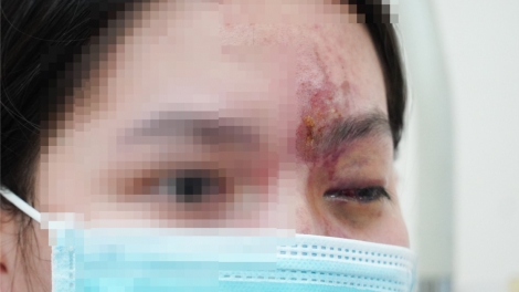 Hiểm họa làm đẹp cấp tốc để đi chơi Tết (21/1/2024)