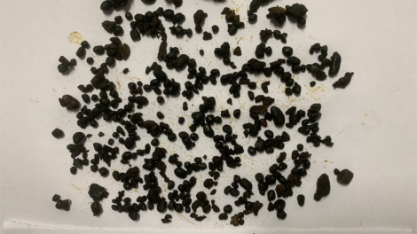 Phẫu thuật lấy gần 1.000 viên sỏi đường mật trong gan bệnh nhân (03/08/2024)